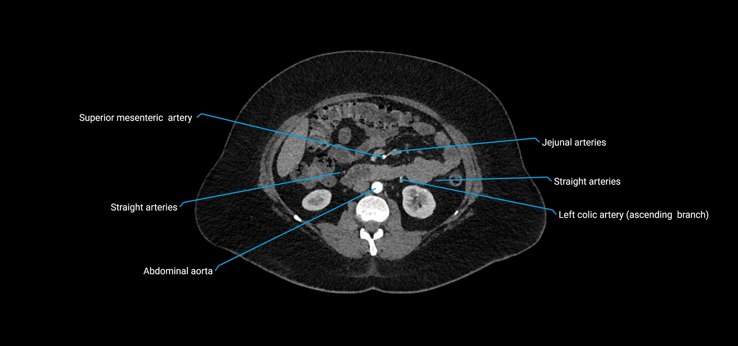 CTA abdomen axial cross sectional anatomy labelled image_89 (2).webp